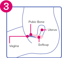 Diagram to show step 3 of inserting a soft cup